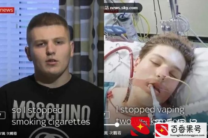 拳击手少年吸电子烟6个月 肺部烂如80岁老烟枪进ICU