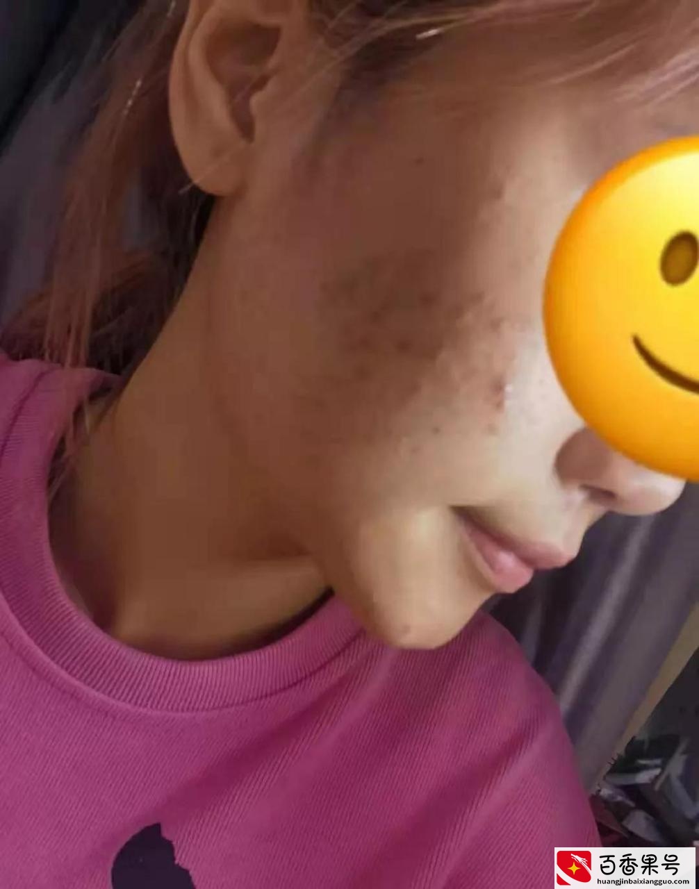 去医院皮肤科看痘痘真的靠谱吗？