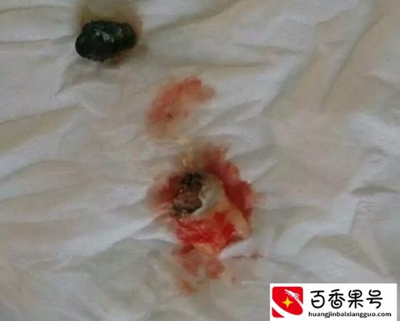 为什么女人长智齿命好