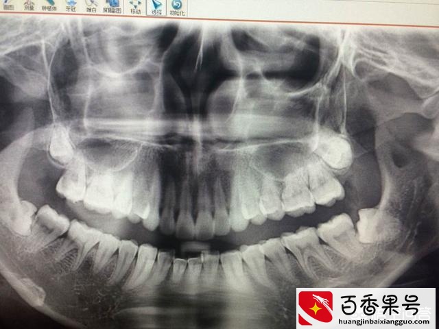 为什么女人长智齿命好