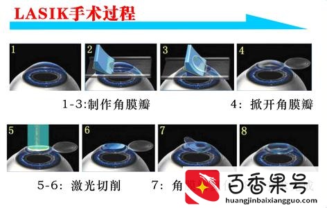 “不差钱”的他们为什么宁愿戴眼镜也不做近视手术？