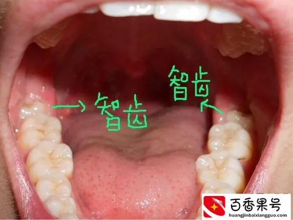 一颗智齿，险些害了母子性命！