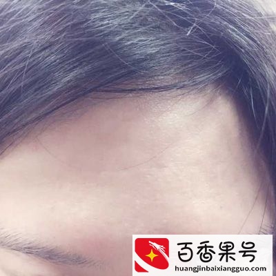 发际线过高的原因是什么
