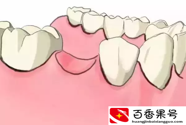 图解：种牙与镶牙的区别！