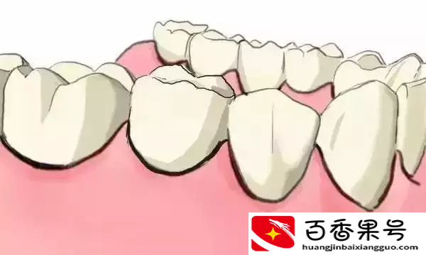 图解：种牙与镶牙的区别！
