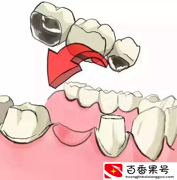 图解：种牙与镶牙的区别！