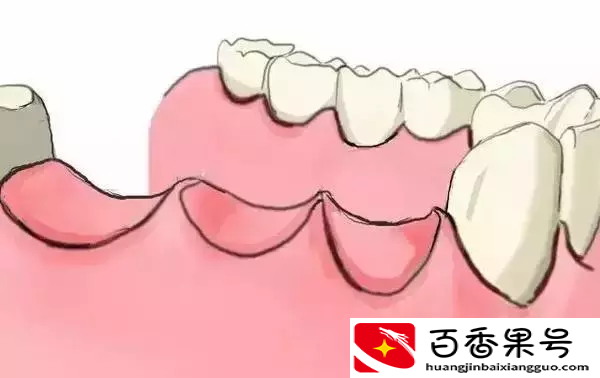 图解：种牙与镶牙的区别！