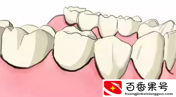 图解：种牙与镶牙的区别！