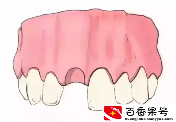 图解：种牙与镶牙的区别！