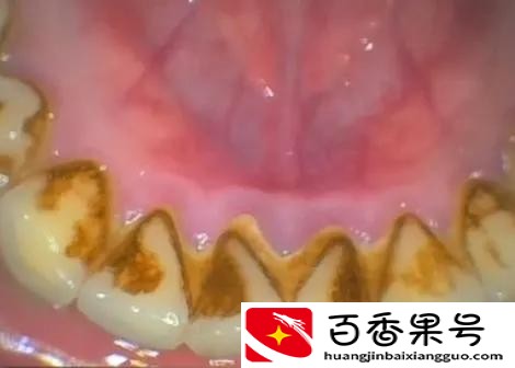 到底该不该洗牙，听听专业医生怎么说
