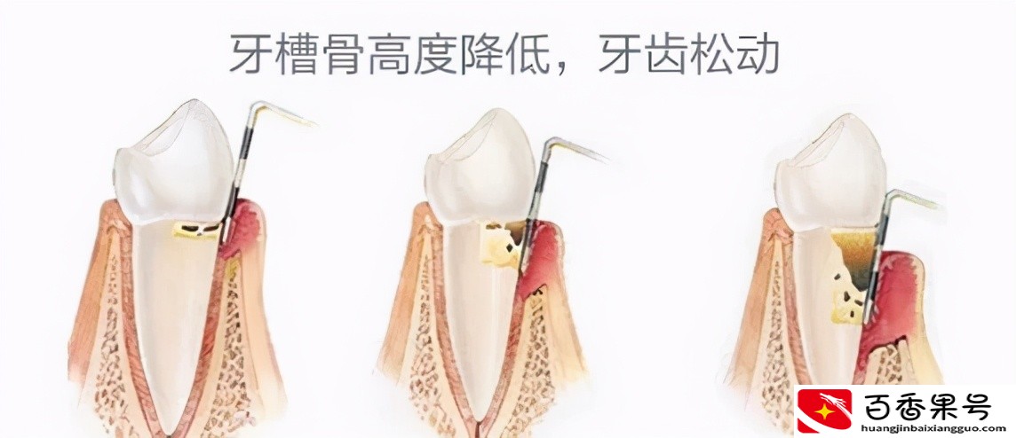 为什么很多人不愿意洗牙？洗牙对牙齿真的有伤害吗？
