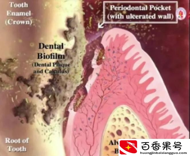 到底该不该洗牙，听听专业医生怎么说