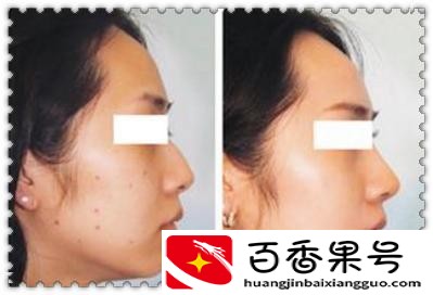 点痣后需要注意什么事项