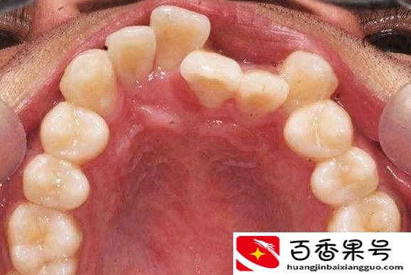 30岁矫正牙齿我后悔了