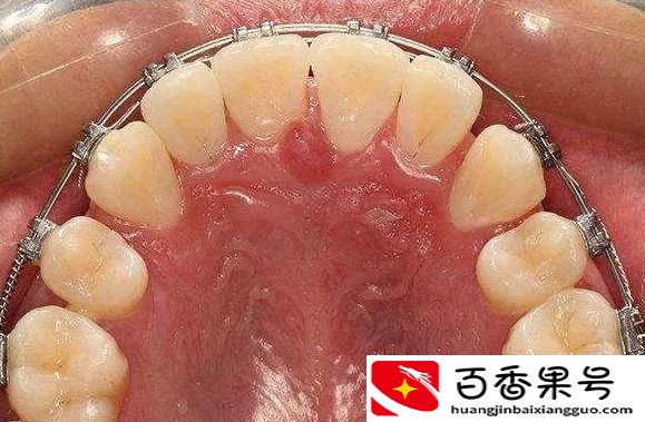 30岁矫正牙齿我后悔了