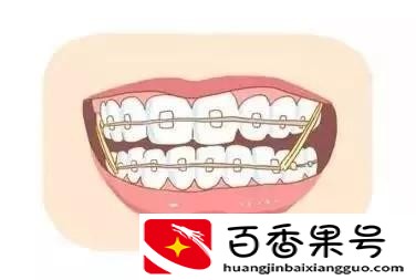 30岁矫正牙齿我后悔了