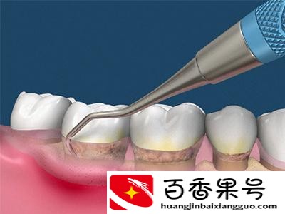 欧洲美国已经禁止洗牙？为什么有些人不能洗牙？