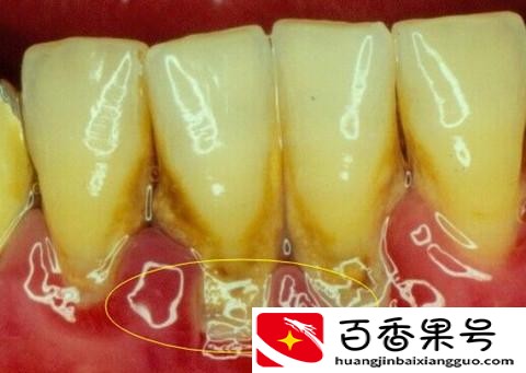 欧洲美国已经禁止洗牙？为什么有些人不能洗牙？