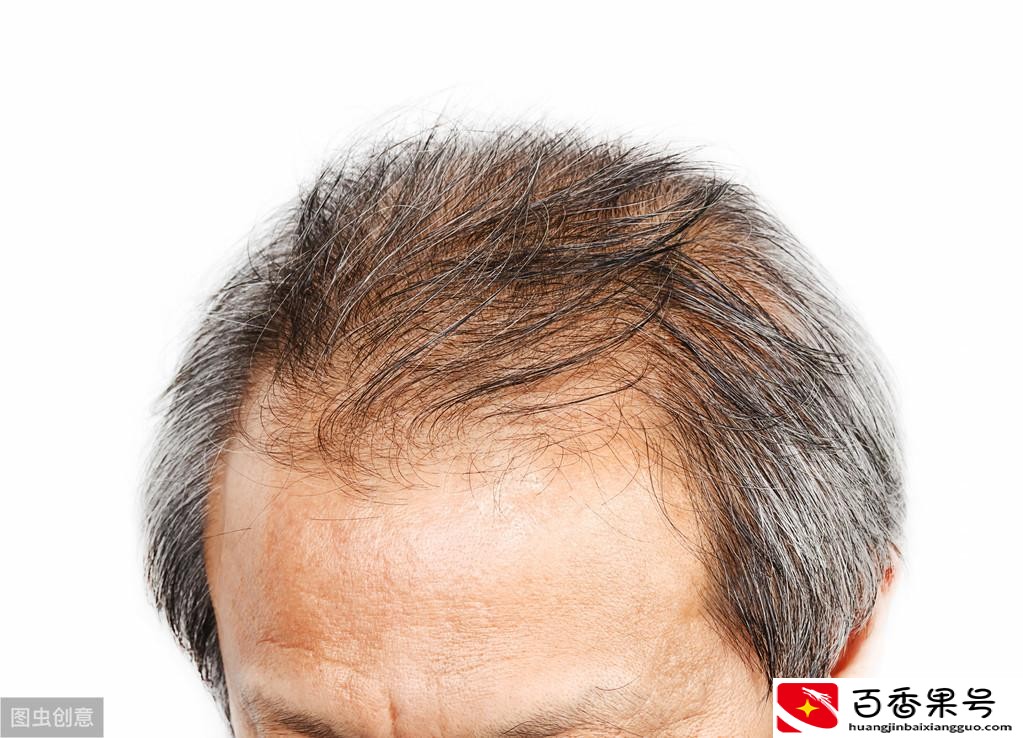 海飞丝会导致脱发吗